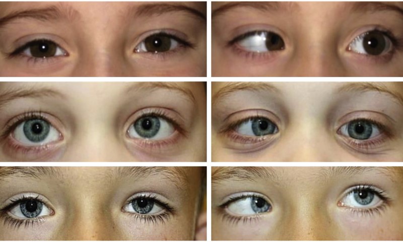 قبل و بعد درمان انحراف چشم